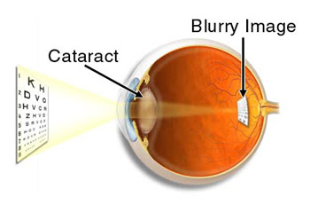 cataract